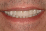 Frontal view demonstrating properly contoured maxillary restorations and improved color.