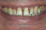 Exaggerated smile to determine gingival display.
