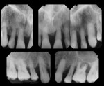 Case 2 periapical radiographs of maxillary teeth prior to treatment. These were used to establish the condition of the dentition, not for treatment planning of implant placement.