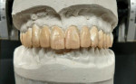 Fig 4. Wax was applied directly over the unprepared tooth structures to maintain the same dimensional space.
