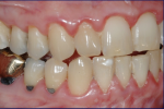Fig 7. Female patient with mild–moderate periodontitis (Fig 7 through Fig 9).