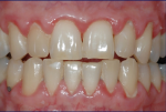 Fig 8. Female patient with mild–moderate periodontitis (Fig 7 through Fig 9).