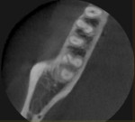 Tooth No. 31 periapical with no fracture evidence, and tooth No. 31 CBCT with clear fracture of the mesial root.