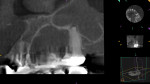 Extraction was eliminated as a treatment option due to BRONJ of a palatal torus. CBCT images were necessary to make the diagnosis because of the patient’s inability to tolerate traditional radiographs.