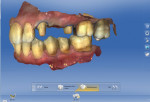 CEREC Biogeneric Individual software compiled three scans to mimic the patient’s bite in maximum intercuspation.