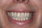 Fig. 8 View at 6 months shows elimination of gingival display and a beautiful smile.