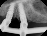 (6.) Pretreatment digital radiograph, maxillary left.