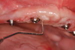 (3.) Excessive probing depth, anterior right implant.