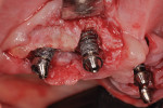 (11.) Implant surface appearance after additional detoxification with an Er:Cr:YSGG laser.