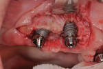 (9.) Implant surface appearance after mechanical and chemical detoxification, maxillary right quadrant.