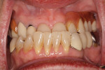 (1.) Patient’s preoperative Class III malocclusion.