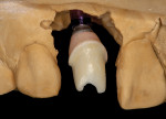 (12.) An “H” abutment is fabricated by the dental lab.