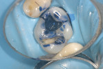Figure 5A Methylene blue dye application to dentin after removing amalgam restoration at 5X magnification.