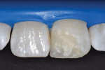 Dentinal mamelons built with microfilled resin composite.