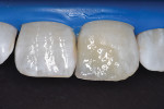 Application of white tint to replicate white spots present on adjacent teeth.