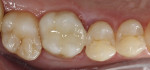 Postoperative view of tooth No. 3.