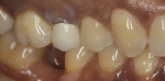 Porcelain-fused-to-metal crown on tooth No. 4 with supragingival margin and exposed dark
stump.