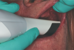 Fig 2. Using the Trios intraoral scanner to capture the edentulous arch.