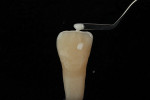 White composite is placed along the incisal edge to accent the “incisal halo.”