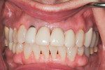 Preoperative retracted view showing discolorations, failing margins, and horizontal imbalance of incisor lengths.