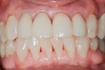 The completed porcelain-fused-to-zirconia crowns following placement.