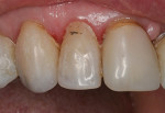 Failed laboratory-processed resin composite crown on the maxillary right lateral incisor.