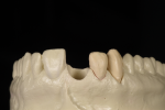 Fig 4. Removable alveolar cast with tooth removed. This facial position view shows how the soft tissue is supported by the tooth and root form.