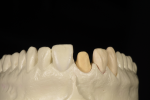 Fig 6. Removable alveolar cast with tooth removed. The incisal position view shows the form dictated by the emergence profile of the individual tooth. Each tooth emergence profile is different and should follow the individual form of its root emergence.