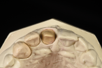 Fig 7. Removable alveolar cast with central shown from the incisal edge shows the marginal position of the preparation and the need for the technician to support the surrounding tissue marked in red.