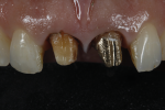 Fig 3. Initial situation, after the removal of the old crowns. The discoloration of No. 8 is obvious, as well as the problem that it would cause to the value and the illusion of depth of the gold cast post of No. 9.