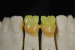 Fig 7. Opaque dentin A2 for No. 9 and opaque dentin A2 mixed with 20% opaque dentin white for No. 8.
