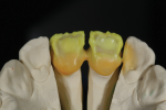 Fig 8. Palatal view with opaque dentin and cervical translucent.