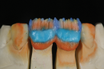Fig 14. T-Blue opalescence to increase depth illusion in the middle of the teeth.