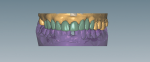 Fig 1. Using exocad in a CAD environment to design restoration.