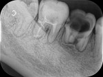 This case depicts a 28-year-old female patient who developed submandibular and
sublingual cellulitis and ecchymosis resulting from an untreated periapical abscess associated with teeth Nos. 30 and 31. The patient was hospitalized and administered IV clindamycin in conjunction with the definitive dental treatment of both teeth. She recovered well, as indicated by the resolution of swelling and ecchymosis within 1 week. Case courtesy of Chih-Wen Chi, DDS, PhD..
