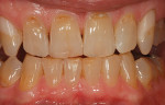 Preoperative tetracycline staining in a bruxism patient often requires several trays for extended treatment.