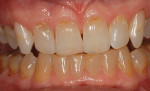 Posttreatment with 10% carbamide peroxide,
teeth are lighter, but not white. One arch treatment improves compliance and helps demonstrate effectiveness.