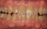 Moderately tetracycline-stained teeth that demonstrate uniform discoloration without severe gingival discoloration.