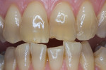 Tetracycline discoloration is not located at the difficult gingival area in this patient, which improves the prognosis.