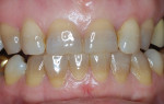 Tetracycline discoloration at the gingival area
is less predictable, especially with multiple analogs causing different discolorations.