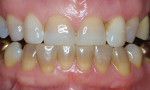 Bleaching yields improvement, but not much change at the gingival area, even with use of a nonscalloped tray.