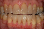 Moderately tetracycline-stained teeth with exposed root surfaces require informing the patient of the prognosis of the exposed root.