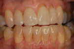 Six months of nightly bleaching with 10% carbamide peroxide lightens the teeth, but the root surfaces remain discolored.