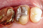 Damage to adjacent gold crown that occurred during preparation of maxillary first molar
for full contoured zirconia restoration.