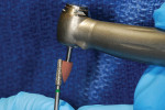 Brownie metal polishing point inserted into
handpiece for reshaping.