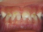 Early Childhood Caries Pre-Treatment Lesions. Image courtesy of Travis M. Nelson, DDS, MSD, MPH.