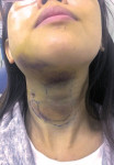 This case depicts a 28-year-old female patient who developed submandibular and
sublingual cellulitis and ecchymosis resulting from an untreated periapical abscess associated with teeth Nos. 30 and 31. The patient was hospitalized and administered IV clindamycin in conjunction with the definitive dental treatment of both teeth. She recovered well, as indicated by the resolution of swelling and ecchymosis within 1 week. Case courtesy of Chih-Wen Chi, DDS, PhD.