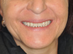 Fig 10. Ideal smile and lip support 6 months after insertion of the LOCATOR F-Tx supported bridge. By allowing the patient to test phonetics, function, esthetic outcome, and muscular adaptation, a new definitive bridge can be fabricated