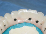 Fig 4. Lingual openings to process denture attachment housing.