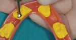 Fig 4. An indexing material was used to pick up the location/position of the denture attachment housing in the denture.